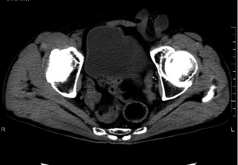 Incidental Discovery of Complications of Cryptorchidism During Laparoscopic Inguinal Hernia Surgery.
