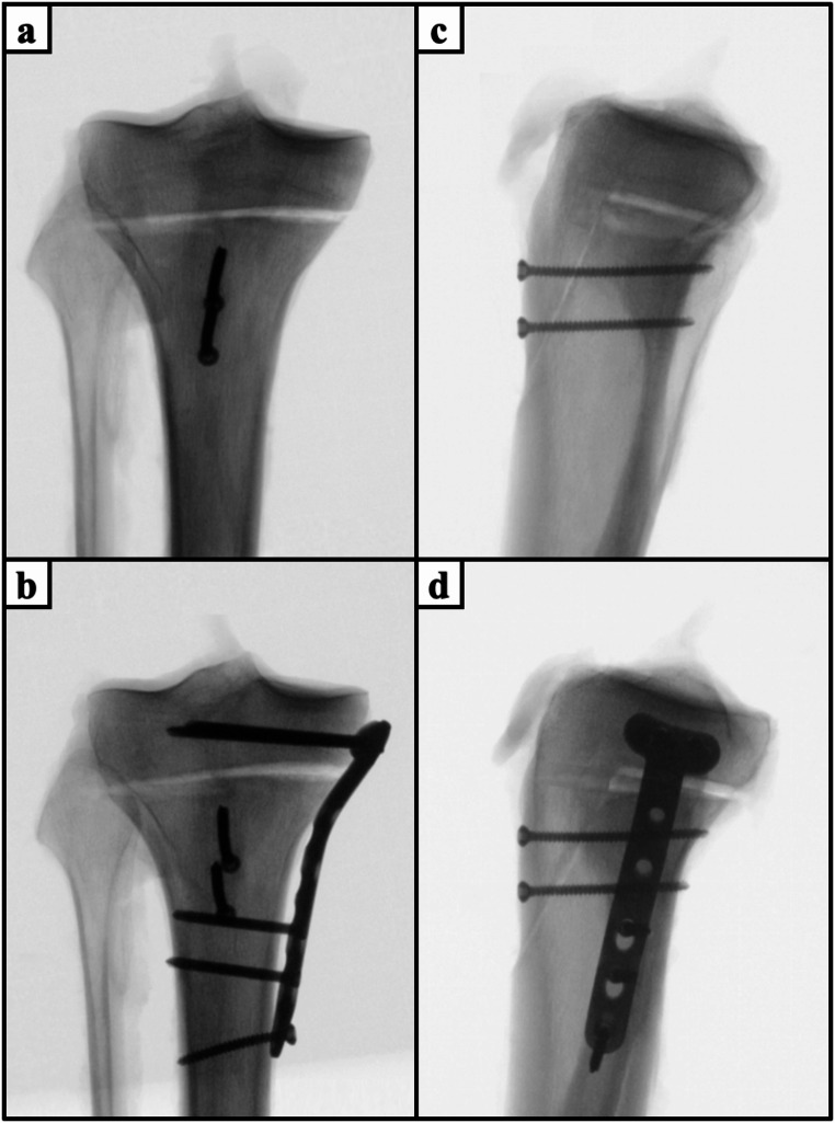 Combined apophyseal and epiphyseal fixation of Ogden type IIIA/IV tibial tubercle avulsion fractures provides favorable stability compared to isolated apophyseal screw fixation - a biomechanical study.