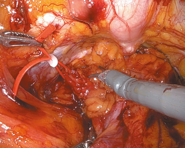 Robot‑assisted surgical management of mid‑urethral sling erosion into the bladder using transperitoneal robotic extensive approach for total mesh excision.