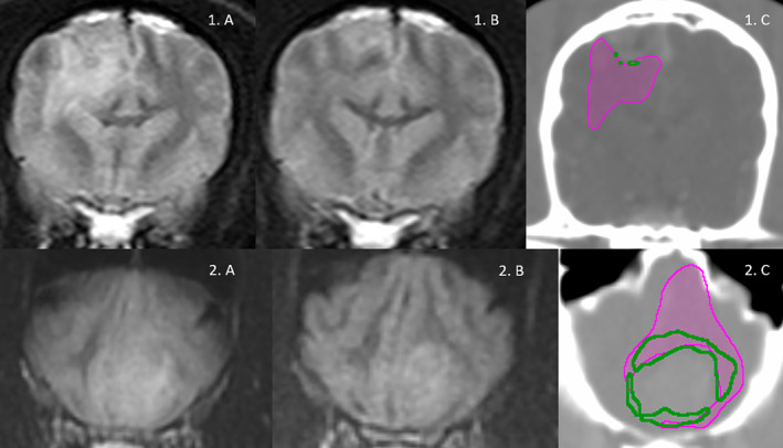 Peritumoral Edema in Canine Extra-Axial Brain Tumours: Effect of Steroids.