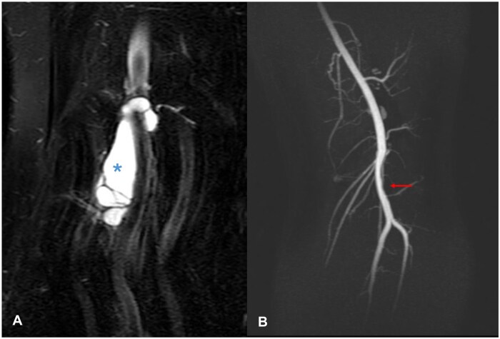 Meniscal tear of the knee causing cystic adventitial disease of popliteal artery: support for the synovial theory.