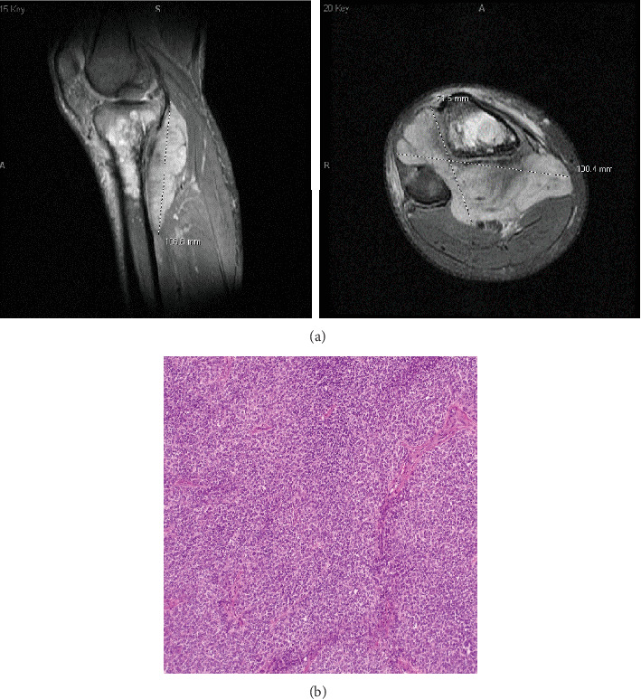 The Importance of Next-Generation Sequencing in Identifying Immunohistochemically Ambiguous Pediatric Sarcomas.