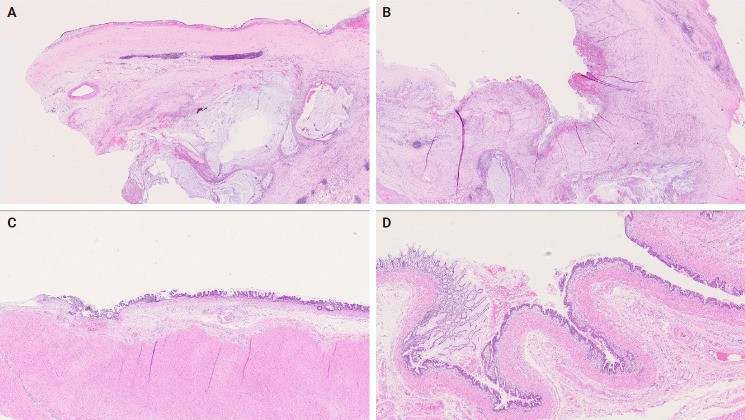 Mucocele of the rectal stump: mucinous cystic neoplasm with low-grade dysplasia simulating low-grade appendiceal mucinous neoplasm.