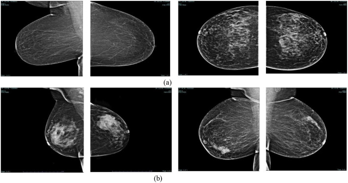 (KAUH-BCMD) dataset: advancing mammographic breast cancer classification with multi-fusion preprocessing and residual depth-wise network.