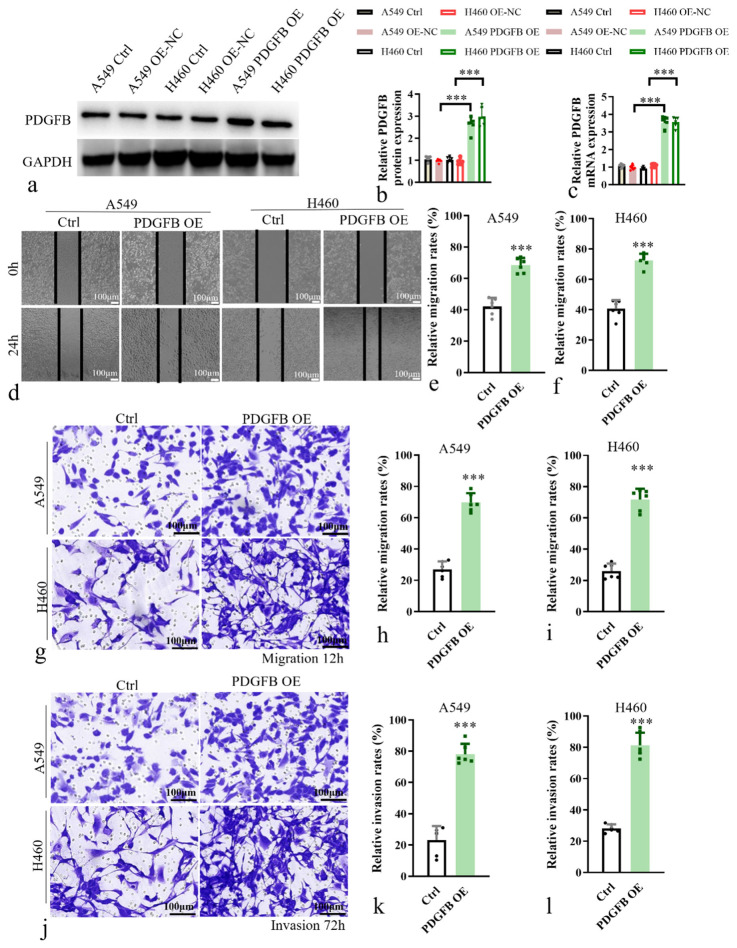 Platelet-derived growth factor subunit B overexpression promotes lung cancer tumor growth and metastasis: The role of glucose metabolism.