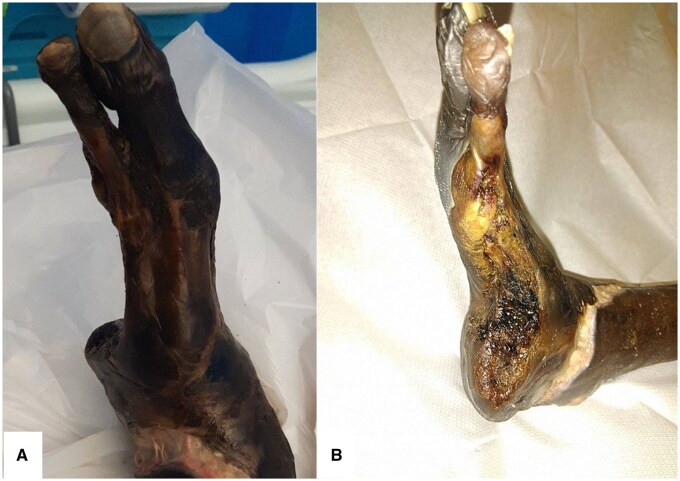 Soft tissue and intraosseous pneumatosis secondary to diabetic foot ulcer: a severe case of emphysematous osteomyelitis.