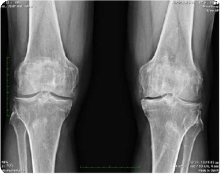 Diffuse Idiopathic Skeletal Hyperostosis, beyond the Axial Skeleton: Extra-spinal DISH.