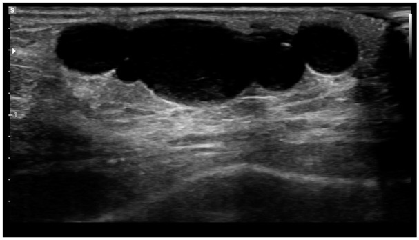 Clinical and Pathological Features of a Schwannoma Harboring a <i>SH3PXD2A::HTRA1</i> Gene Fusion in a Pre-pubescent Patient.