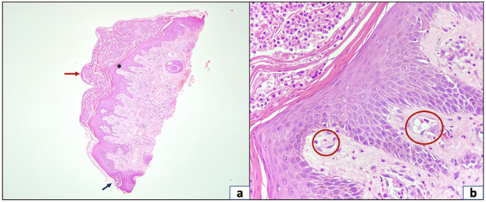 Pustular psoriasis of pregnancy with paradoxical facial involvement: an uncommon presentation-what is your diagnosis?