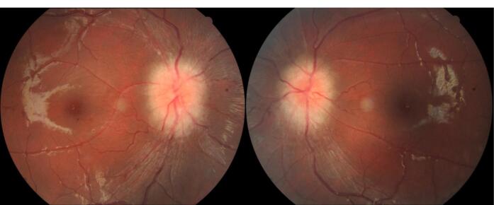 Idiopathic Intracranial Hypertension.