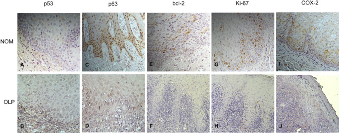 Molecular Markers in Oral Lichen Planus - Insight into Pathogenesis.