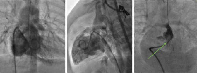 Comparative Study on the Outcomes of Right Ventricular Outflow Tract Stenting vs. Modified Blalock-Taussig Shunt in Patients with Tetralogy of Fallot: A Prospective Randomized Trial.