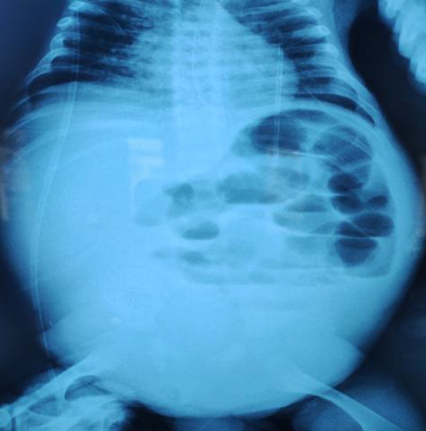 Secondary congenital nephrotic syndrome complicated by acute mesenteric ischemia: A case report.