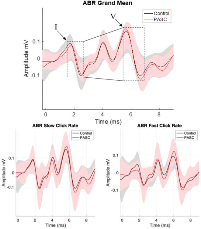 Altered auditory brainstem responses are post-acute sequela of SARS-CoV-2 (PASC).