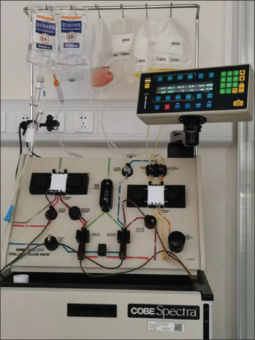A standardized protocol for modified platelet-rich plasma collection for the treatment of interstitial cystitis/bladder pain syndrome.