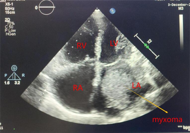Clinical characteristics and surgical outcomes following cardiac myxoma resection.