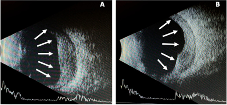Rare bilateral corneoscleral perforation secondary to ocular tuberculosis: a case report and clinical insights.
