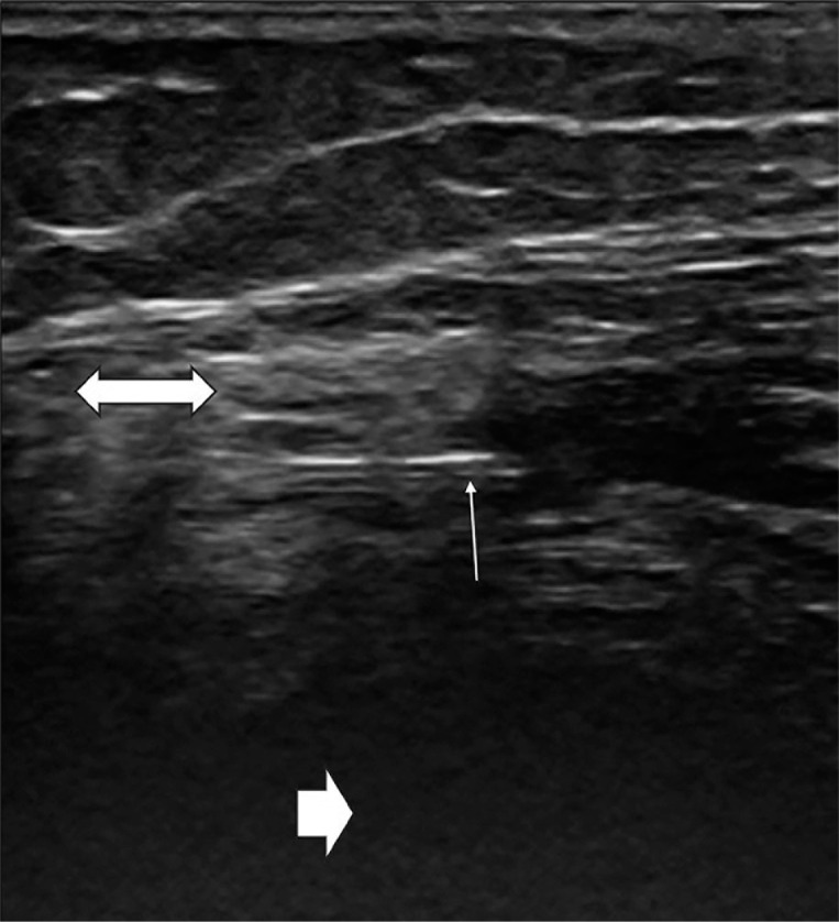 Joints and needles: summary of radiosynoviorthesis.