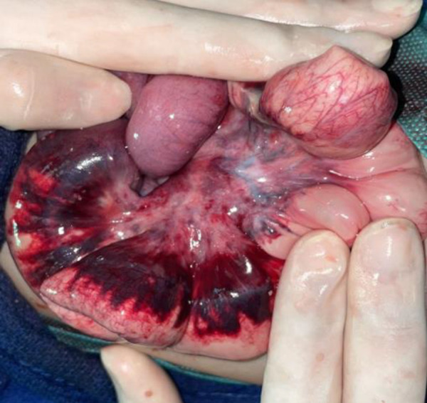 Secondary congenital nephrotic syndrome complicated by acute mesenteric ischemia: A case report.