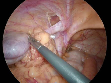 Incidental Discovery of Complications of Cryptorchidism During Laparoscopic Inguinal Hernia Surgery.