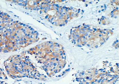 Sustained Remission With Atezolizumab in a Frail, Geriatric Patient With Advanced-Stage Large Cell Neuroendocrine Carcinoma Lung.