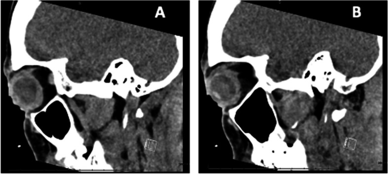 Rare bilateral corneoscleral perforation secondary to ocular tuberculosis: a case report and clinical insights.