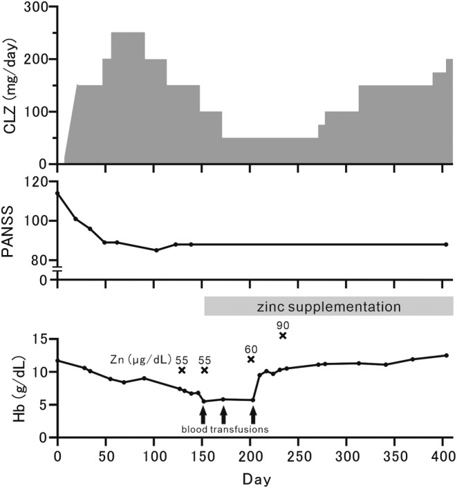 Successful Clozapine Treatment for Treatment-Resistant Schizophrenia With Zinc Deficiency Severe Anemia: A Case Report.