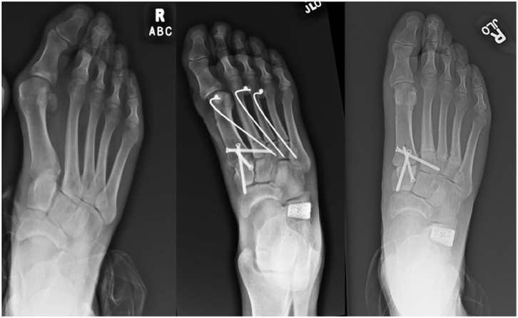 Approaches to Minimally Invasive Surgery for Treatment of Metatarsus Adductus with Hallux Valgus Correction With Modified Lapidus: A Novel Technique Guide.