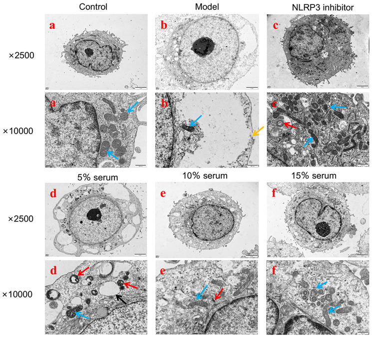 The Effects of Xialiqi Capsules in Regulating the Pyroptosis of Prostate Epithelial Cells Via NLRP3/Caspase-1 Pathway for the Treatment of Chronic Prostatitis.