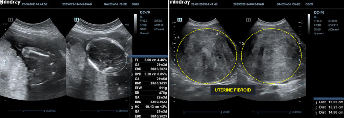 An Unusual and Successful Pregnancy With Multiple Large Uterine Fibroids Delivered by Cesarean Myomectomy.