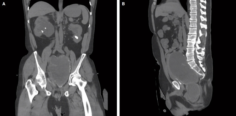 Mucocele of the rectal stump: mucinous cystic neoplasm with low-grade dysplasia simulating low-grade appendiceal mucinous neoplasm.