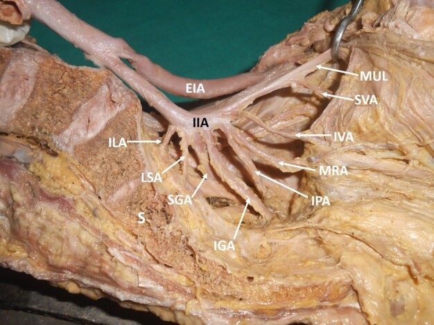 Variations in the branching pattern of the internal iliac artery and its implications in trauma and surgery - a South Indian cadaveric study.