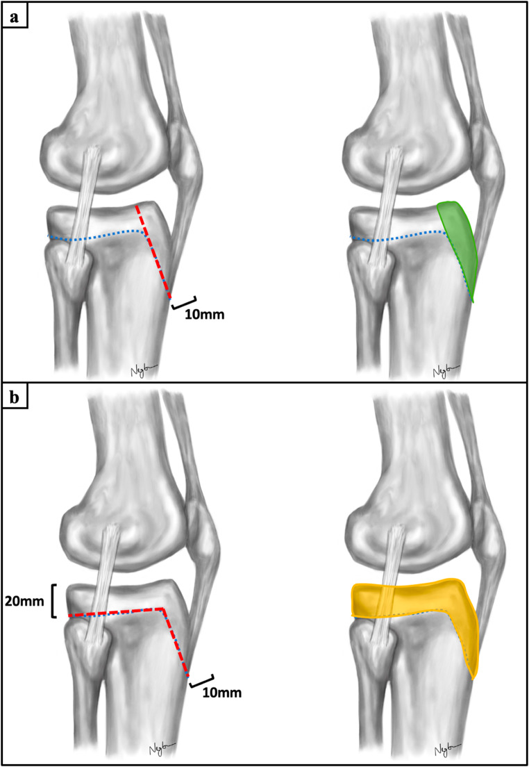Combined apophyseal and epiphyseal fixation of Ogden type IIIA/IV tibial tubercle avulsion fractures provides favorable stability compared to isolated apophyseal screw fixation - a biomechanical study.
