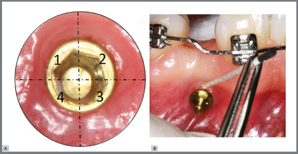 Comparative evaluation of orthodontic mini-implants hygiene protocols on subgingival bacterial load.