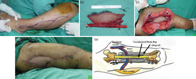 Chimeric Free Fibula Osteocutaneus Flap and Massive Allograft for Refractory Post-traumatic Osteomyelitis Femur Defect: A Case Report.