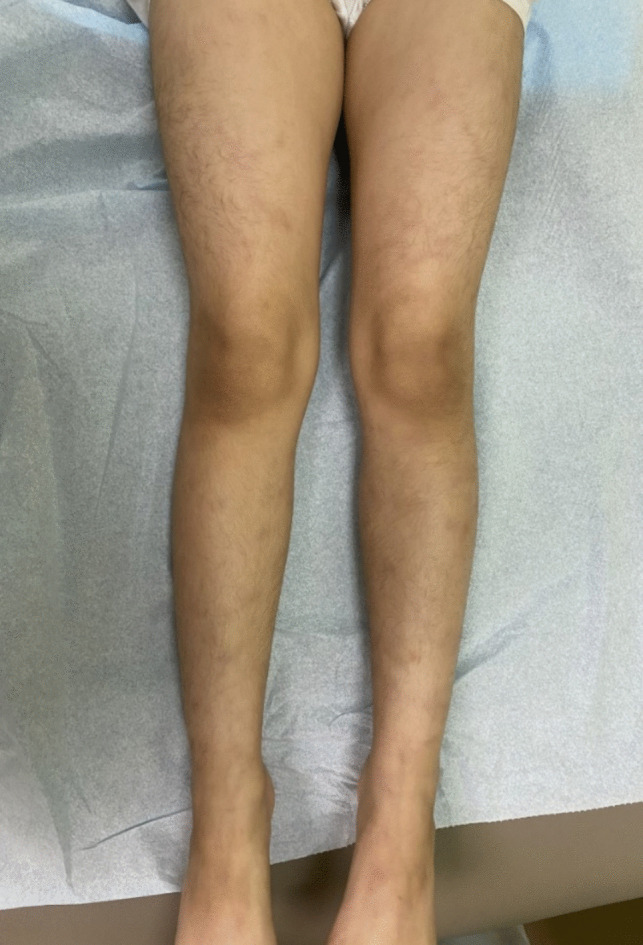 Deficiency of Adenosine Deaminase 2 Masquerading as Behçet's Disease: Phenotypic Mimicry with HLA-B*51 Positivity.