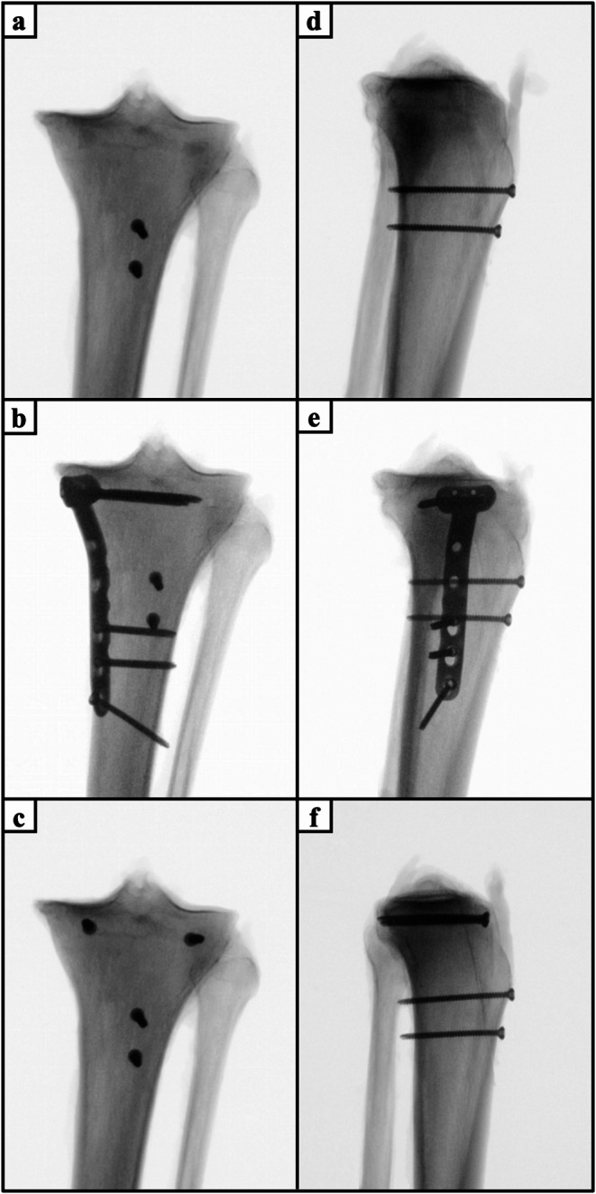 Combined apophyseal and epiphyseal fixation of Ogden type IIIA/IV tibial tubercle avulsion fractures provides favorable stability compared to isolated apophyseal screw fixation - a biomechanical study.
