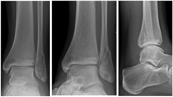 Ligamentous Injuries in Stable Ankle Fractures: An MRI-Based Study.