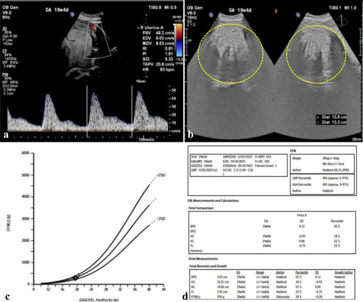 An Unusual and Successful Pregnancy With Multiple Large Uterine Fibroids Delivered by Cesarean Myomectomy.
