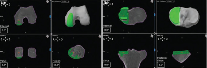 Clinical Outcome Scores Post Medial Unicompartmental Knee Arthroplasty: A Comparison of the MAKO Robotic Arm versus the Oxford Conventional Approach.