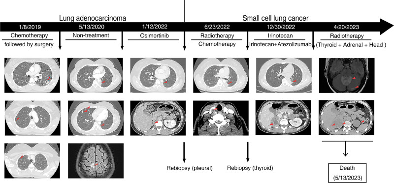 Transformation of lung adenocarcinoma to small cell lung cancer following osimertinib treatment: a case report and literature review.