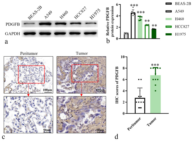 Platelet-derived growth factor subunit B overexpression promotes lung cancer tumor growth and metastasis: The role of glucose metabolism.