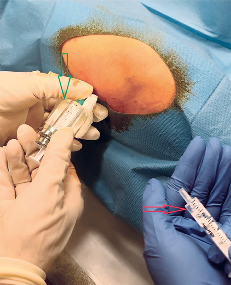 Joints and needles: summary of radiosynoviorthesis.