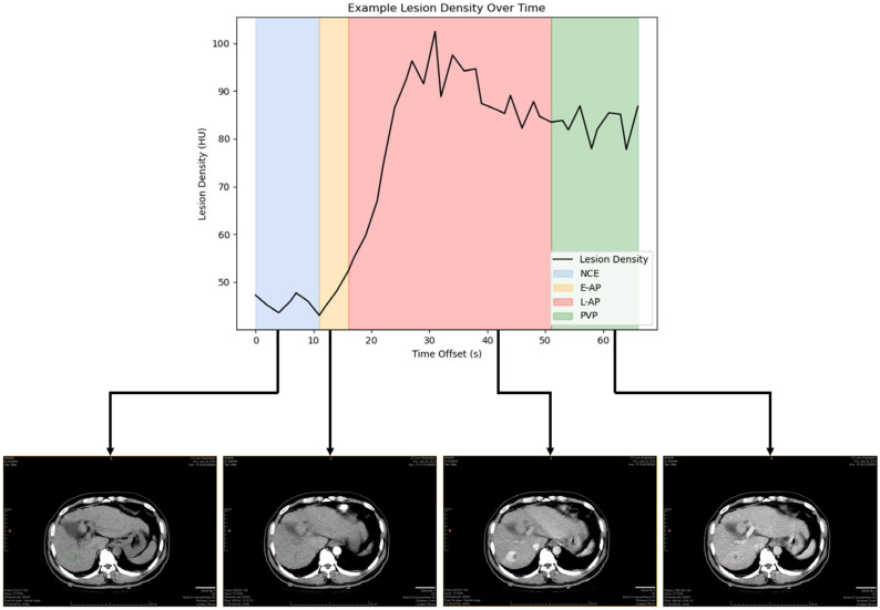 Variability of HCC Tumor Diameter and Density Measurements on Dynamic Contrast-Enhanced Computed Tomography.