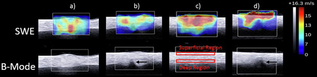 Ultrasound quantitative characterization of tendinopathy with shear wave elastography in an ex vivo porcine tendon model.