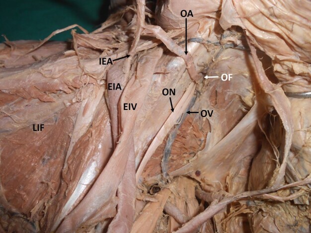 Variations in the branching pattern of the internal iliac artery and its implications in trauma and surgery - a South Indian cadaveric study.