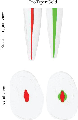 Shaping Ability of the ProTaper Gold and R-Motion Systems in Long-Oval Canals: A Microcomputed Tomography Study.