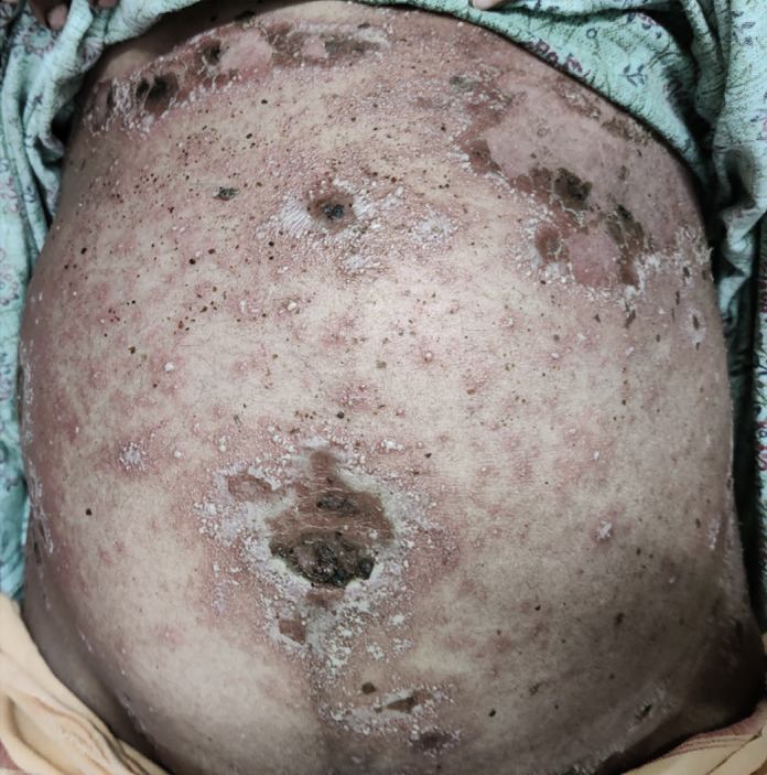 Pustular psoriasis of pregnancy with paradoxical facial involvement: an uncommon presentation-what is your diagnosis?