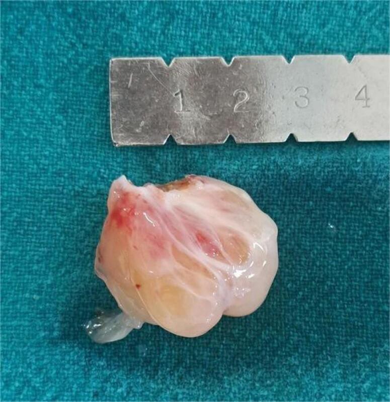 Clinical characteristics and surgical outcomes following cardiac myxoma resection.