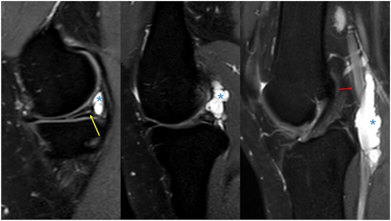 Meniscal tear of the knee causing cystic adventitial disease of popliteal artery: support for the synovial theory.